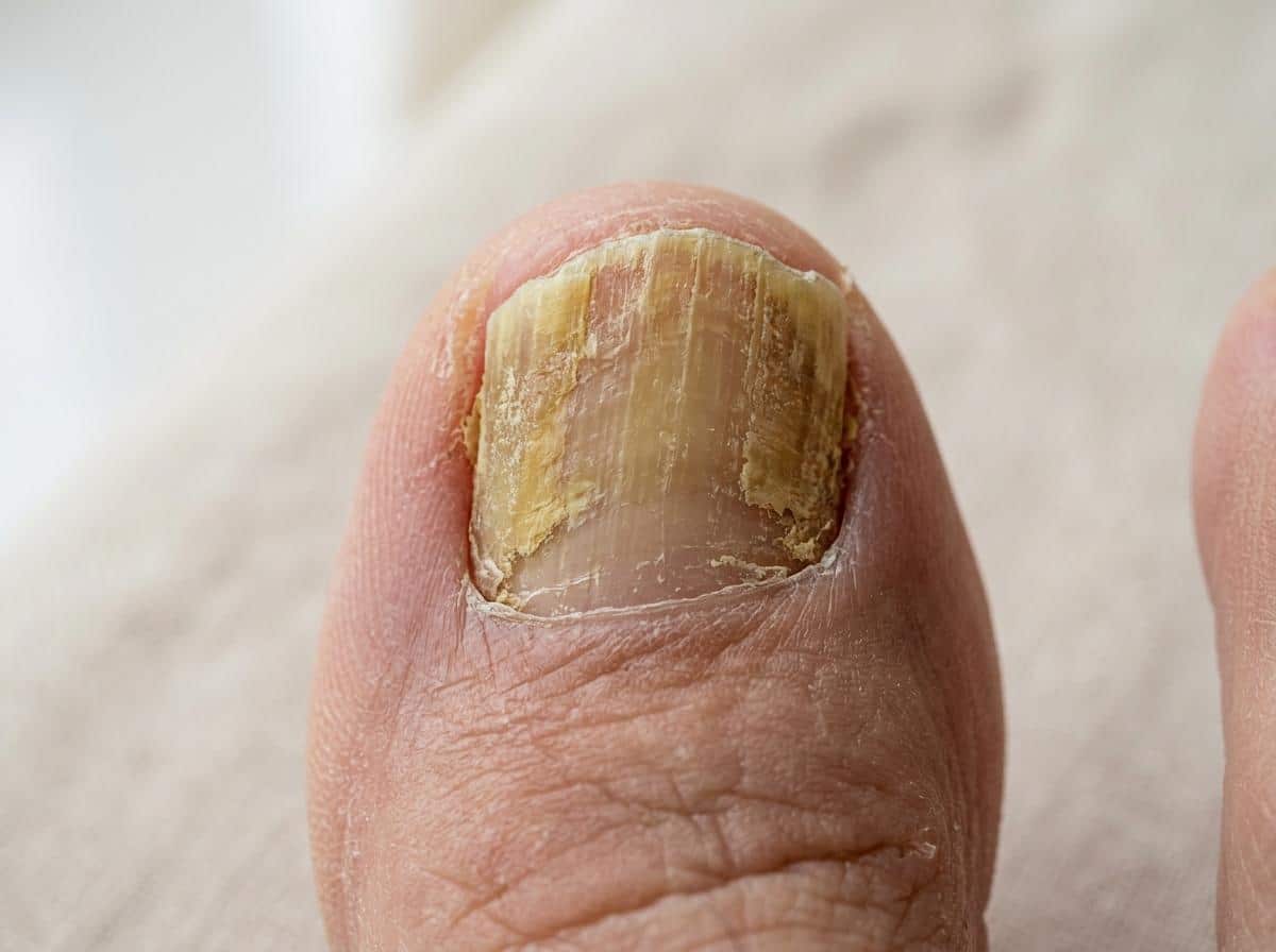 Ongle de pied épaissi jaune mycose gros plan